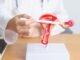 PCOS trở thành PMS: gọi tên chính xác nguyên nhân đầu tiên gây vô sinh nữ để điều trị tốt hơn