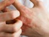 tại sao căn bệnh này cũng có thể ảnh hưởng đến sức khỏe tâm thần?