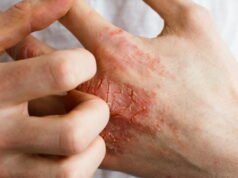 tại sao căn bệnh này cũng có thể ảnh hưởng đến sức khỏe tâm thần?