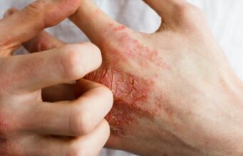 tại sao căn bệnh này cũng có thể ảnh hưởng đến sức khỏe tâm thần?
